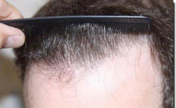 Hair restoration procedure results