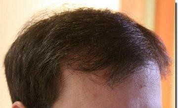 Hair restoration procedure results