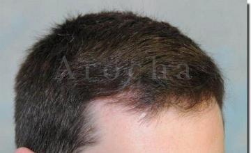 Hair restoration procedure results