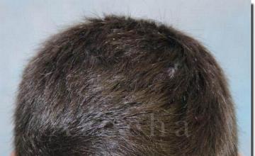 Hair restoration procedure results