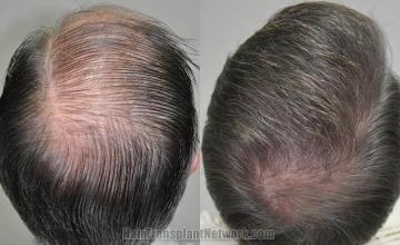 Hair restoration procedure before and after pictures