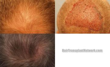 Hair transplantation surgery before and after images