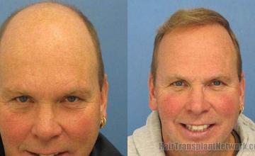 Hair restoration results 4365 grafts