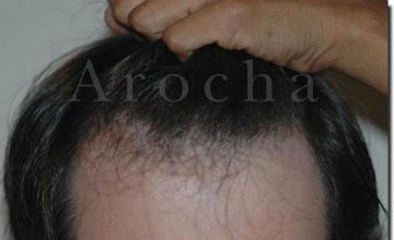 Hair restoration procedure results