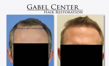 Hair restoration procedure before and after results