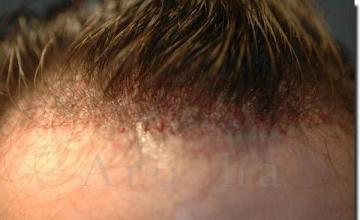 Hair restoration procedure results