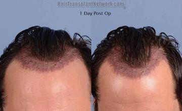 Hair restoration procedure before and after pictures