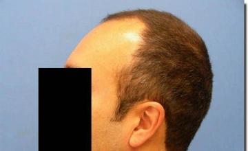 Hair restoration procedure results