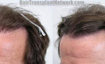 Before and after hair restoration pictures