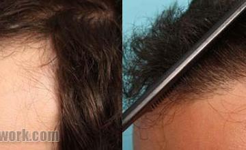 Hair restoration procedure before and after pictures