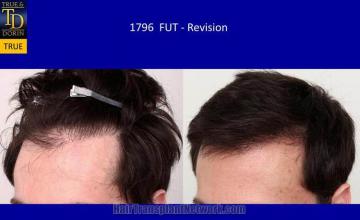 Hair transplantation surgery before and after pictures