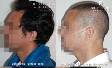 Hair transplantation surgery before and after pictures