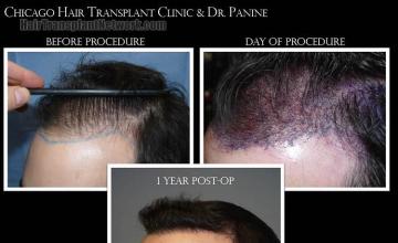 Hair restoration procedure before and after pictures