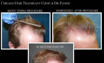 Hair transplantation surgery before and after photos