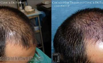 Hair transplantation surgery before and after photos