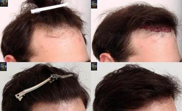 Hair transplantation surgery before and after photos