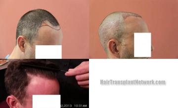 Hair transplantation surgery before and after images