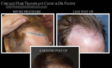 Hair transplantation surgery before and after images