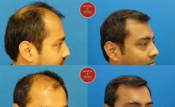 Hair transplantation surgery before and after images