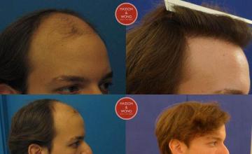 Hair transplantation surgery before and after photos