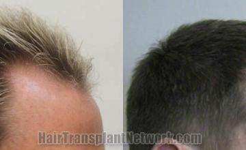 Hair transplantation surgery before and after images