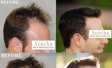 Hair transplantation surgery before and after images