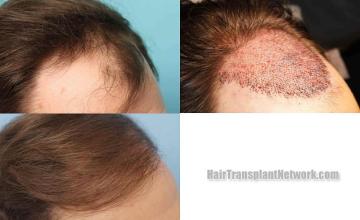 Hair transplantation surgery before and after images