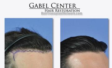 Hair transplant surgery before and after images