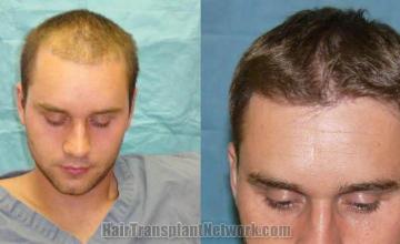 Tilt down view - before and postoperative hair transplant