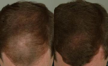 Hair transplantation surgery before and after pictures