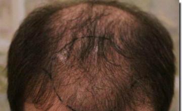 Hair restoration procedure results