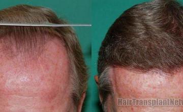 Hair Restoration before and after photo