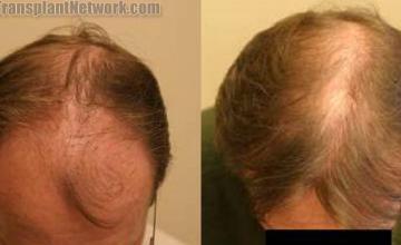 Top view before and after hair restoration results