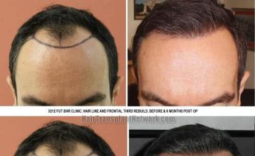 Hair transplantation surgery before and after images