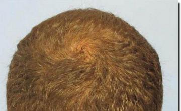 Hair restoration procedure results