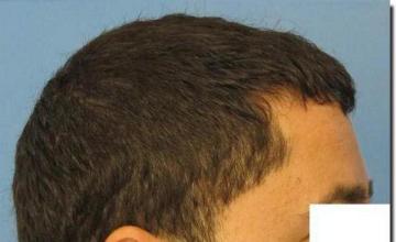 Hair restoration procedure results