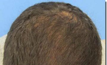 Hair restoration procedure results