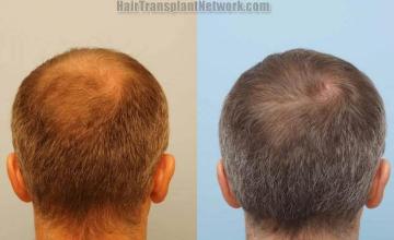 Hair transplantation surgery before and after photos