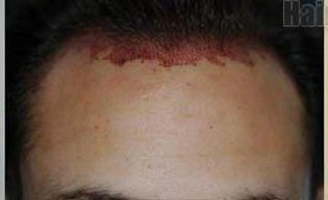 Hair transplant procedure before and after photos 