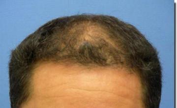 Hair restoration procedure results