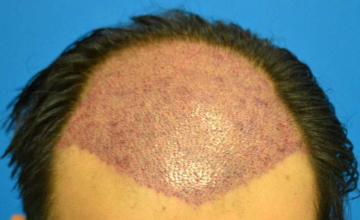 Hair transplant surgery before and after photos