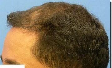 Hair restoration procedure results