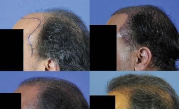 Viewing left side hair replacement surgery results