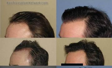 Left view before and after hair transplant