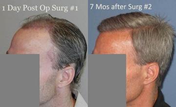 Hair transplantation surgery before and after photos