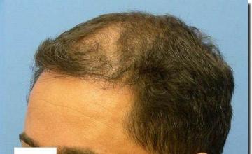 Hair restoration procedure results