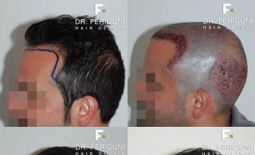 Hair transplantation surgery before and after images