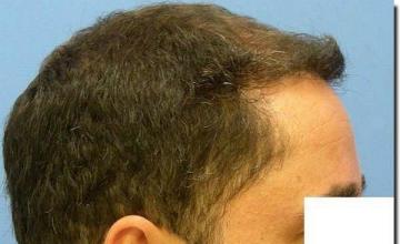 Hair restoration procedure results