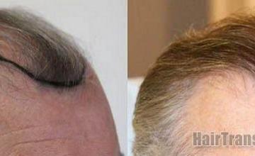 Hair restoration procedure results