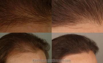 Before and after surgical hair transplantation